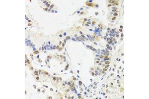 Immunohistochemistry of paraffin-embedded human gastric cancer using SUZ12 antibody (ABIN5975314) at dilution of 1/100 (40x lens). (SUZ12 anticorps)