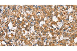 Immunohistochemistry of paraffin-embedded Human thyroid cancer tissue using CSMD1 Polyclonal Antibody at dilution 1:40 (CSMD1 anticorps)