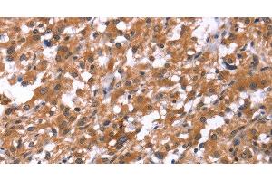 Immunohistochemistry of paraffin-embedded Human thyroid cancer using HSD17B1 Polyclonal Antibody at dilution of 1:40 (HSD17B1 anticorps)