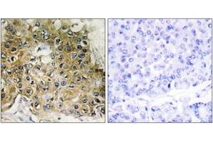 Immunohistochemistry analysis of paraffin-embedded human breast carcinoma, using Integrin beta1 (Phospho-Thr789) Antibody.