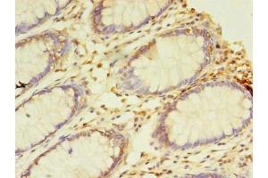 Immunohistochemistry of paraffin-embedded human colon cancer using ABIN7161747 at dilution of 1:100