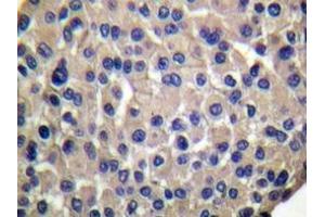Immunohistochemistry analyzes of Mucin 1 antibody in paraffin-embedded human breast carcinoma. (MUC1 anticorps)