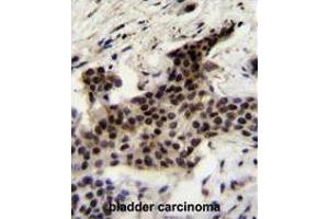 UBXN2A Antibody (C-term) immunohistochemistry analysis in formalin fixed and paraffin embedded human bladder carcinoma followed by peroxidase conjugation of the secondary antibody and DAB staining. (UBXN2A anticorps  (C-Term))