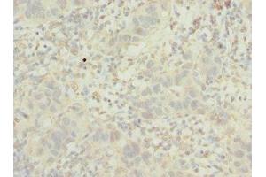 Immunohistochemistry of paraffin-embedded human bladder cancer using ABIN7163723 at dilution of 1:100 (POC1B anticorps  (AA 299-478))