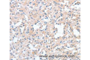 Immunohistochemistry of Human thyroid cancer using WNT3A Polyclonal Antibody at dilution of 1:40 (WNT3A anticorps)
