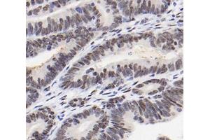 Immunohistochemistry analysis of paraffin-embedded human colon cancer using RBM14 (ABIN7075474) at dilution of 1: 2000 (RBM14 anticorps)