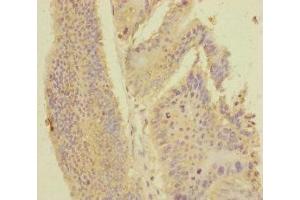 Immunohistochemistry of paraffin-embedded human colon cancer using ABIN7168416 at dilution of 1:100 (PDE6A anticorps  (AA 656-860))