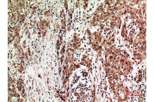 Immunohistochemistry (IHC) analysis of paraffin-embedded Human Breast Cancer, antibody was diluted at 1:100.