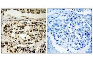 Immunohistochemical analysis of paraffin-embedded human breast carcinoma tissue using Cyclin C (Phospho-Ser275) antibody (left)or the same antibody preincubated with blocking peptide (right). (Cyclin C anticorps  (pSer275))
