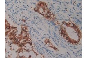 Detection of S100P in Human Bile duct cancer Tissue using Polyclonal Antibody to S100 Calcium Binding Protein P (S100P)