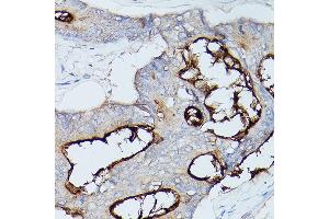 Immunohistochemistry of paraffin-embedded human colon carcinoma using CE Rabbit pAb (ABIN3015546, ABIN3015547, ABIN3015548 and ABIN6218802) at dilution of 1:100 (40x lens).