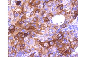 Paraformaldehyde-fixed, paraffin embedded Human lung cancer tissue, Antigen retrieval by boiling in sodium citrate buffer (pH6) for 15min, Block endogenous peroxidase by 3% hydrogen peroxide for 30 minutes, Blocking buffer at 37°C for 20min, Antibody incubation with Cytokeratin 16 (1A4) Monoclonal Antibody  at 1:50 overnight at 4°C, followed by a conjugated secondary and DAB staining.