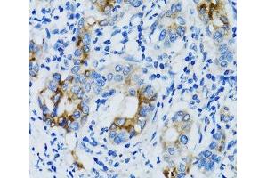 Immunohistochemistry of paraffin-embedded Human gastric cancer using MMP7 Polyclonal Antibody at dilution of 1:100 (40x lens). (MMP7 anticorps)