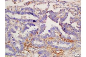 Formalin-fixed and paraffin embedded human lung carcinoma labeled with Anti-IL-12 beta Polyclonal Antibody, Unconjugated  at 1:200 followed by conjugation to the secondary antibody and DAB staining. (IL12B anticorps  (AA 201-300))