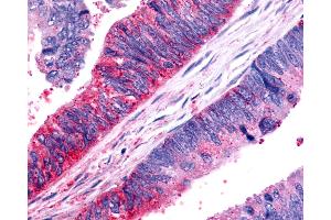 Anti-FZD7 / Frizzled 7 antibody IHC of human Colon, Carcinoma.