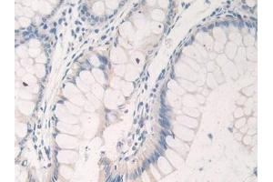 Detection of NCCT in Human Colorectal cancer Tissue using Polyclonal Antibody to Na-Cl Cotransporter (NCCT)