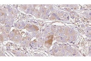 ABIN6272735 at 1/100 staining Human liver cancer tissue by IHC-P. (LPAR4 anticorps  (C-Term))