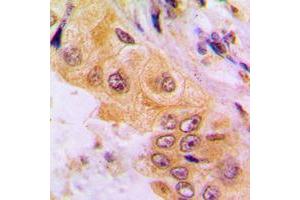 Immunohistochemical analysis of Cytochrome P450 2A7 staining in human liver cancer formalin fixed paraffin embedded tissue section.