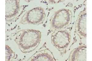 Immunohistochemistry of paraffin-embedded human colon cancer using ABIN7163613 at dilution of 1:100 (PLA2G7 anticorps  (AA 49-441))