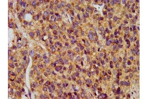 IHC image of ABIN7159750 diluted at 1:400 and staining in paraffin-embedded human glioma performed on a Leica BondTM system. (MAP1A anticorps  (AA 1979-2168))