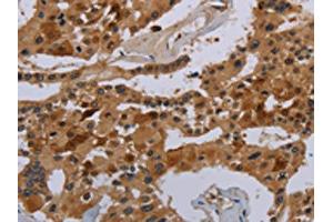 The image on the left is immunohistochemistry of paraffin-embedded Human prostate cancer tissue using ABIN7190333(COX18 Antibody) at dilution 1/20, on the right is treated with synthetic peptide. (COX18 anticorps)