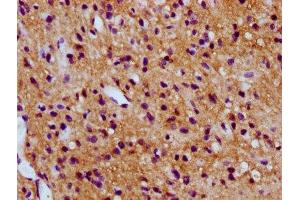 IHC image of ABIN7171107 diluted at 1:300 and staining in paraffin-embedded human glioma performed on a Leica BondTM system.