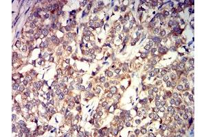Immunohistochemical analysis of paraffin-embedded bladder cancer tissues using GRIK4 mouse mAb with DAB staining.