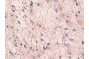 Detection of IL1R1 in Human Glioma Tissue using Polyclonal Antibody to Interleukin 1 Receptor Type I (IL1R1)