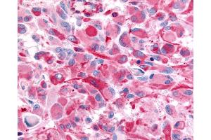 Anti-CHRM2 / M2 antibody IHC of human Brain, Glioblastoma. (Muscarinic Acetylcholine Receptor M2 anticorps  (Cytoplasmic Domain))