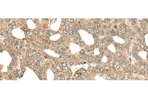 Immunohistochemistry of paraffin-embedded Human liver cancer tissue using APC Polyclonal Antibody at dilution of 1:45(x200) (APC anticorps)