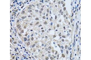 Immunohistochemistry of paraffin-embedded Human lung cancer using LSM4 Polyclonal Antibody at dilution of 1:100 (40x lens). (LSM4 anticorps)