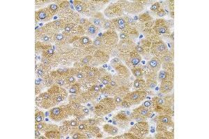 Immunohistochemistry of paraffin-embedded human liver damage using Mitofusin 2 antibody (ABIN6128301, ABIN6143801, ABIN6143804 and ABIN6217669) (40x lens).