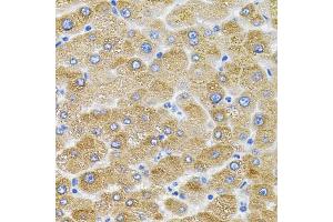Immunohistochemistry of paraffin-embedded human liver damage using Mitofusin 2 antibody (ABIN6128301, ABIN6143801, ABIN6143804 and ABIN6217669) (40x lens). (MFN2 anticorps  (AA 687-757))
