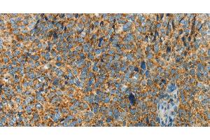 Immunohistochemistry of paraffin-embedded Human cervical cancer using BCAT2 Polyclonal Antibody at dilution of 1:70 (BCAT2 anticorps)