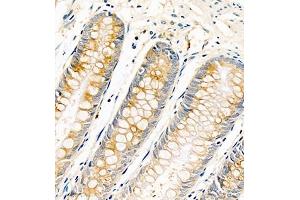 Immunohistochemistry of paraffin embedded human colon cancer using AnnexinA13 (ABIN7073061) at dilution of 1:1500 (400x lens)