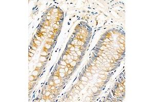 Immunohistochemistry of paraffin embedded human colon cancer using AnnexinA13 (ABIN7073061) at dilution of 1:1500 (400x lens) (Annexin A13 anticorps)