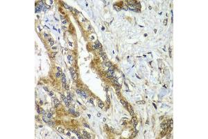Immunohistochemistry of paraffin-embedded human liver cancer using CDC16 antibody (ABIN5974330) at dilution of 1/100 (40x lens). (CDC16 anticorps)