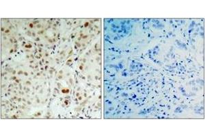 Immunohistochemistry analysis of paraffin-embedded human breast carcinoma, using Retinoblastoma (Phospho-Ser807) Antibody. (Retinoblastoma Protein (Rb) anticorps  (pSer807))