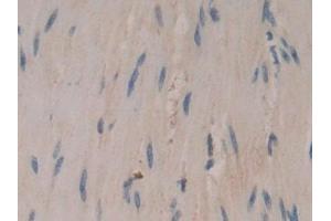 Detection of CORO1A in Human Colorectal cancer Tissue using Polyclonal Antibody to Coronin 1A (CORO1A)