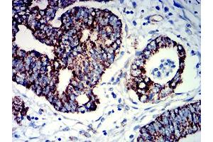 Immunohistochemical analysis of paraffin-embedded rectum cancer tissues using PIGR mouse mAb with DAB staining.