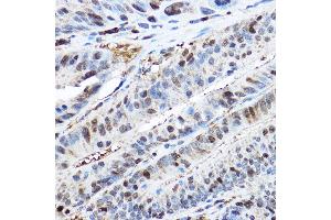 Immunohistochemistry of paraffin-embedded human colon carcinoma using CDK2 Rabbit pAb  at dilution of 1:200 (40x lens). (CDK2 anticorps)