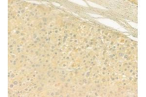 ABIN6259782 and ABIN6279085 at 1/100 staining human hepatocellular carcinoma by IHC-P.