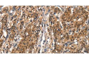Immunohistochemistry of paraffin-embedded Human gastric cancer tissue using DDX4 Polyclonal Antibody at dilution 1:40 (DDX4 anticorps)