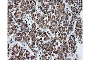 Immunohistochemical staining of paraffin-embedded Carcinoma of liver tissue using anti-FAHD2A mouse monoclonal antibody. (FAHD2A anticorps)