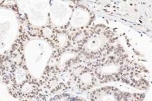 Immunohistochemistry analysis of paraffin-embedded human gastric cancer using Ring1A (ABIN7075467) at dilution of 1: 3600