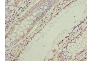 Immunohistochemistry of paraffin-embedded human colon cancer using ABIN7161338 at dilution of 1:100 (NMUR1 anticorps  (AA 360-426))