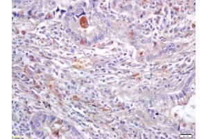 Formalin-fixed and paraffin embedded human lung carcinoma labeled with Anti-ERK2/MAPK1 Polyclonal Antibody, Unconjugated (ABIN723725) at 1:200 followed by conjugation to the secondary antibody and DAB staining