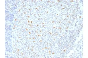 Formalin-fixed, paraffin-embedded human Hodgkin's Lymphoma stained with BCL-6 Mouse Monoclonal Antibody (BCL6/1526). (BCL6 anticorps  (AA 256-389))
