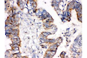 Anti- IGFBP3 Picoband antibody, IHC(P) IHC(P): Human Intestinal Cancer Tissue