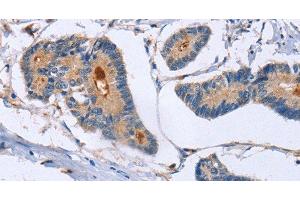 Immunohistochemistry of paraffin-embedded Human colon cancer using GMFG Polyclonal Antibody at dilution of 1:50 (GMFG anticorps)